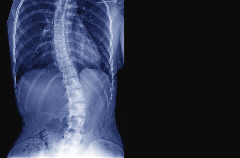 X-ray image of a person that has scoliosis, or an abnormal curvature of the spine